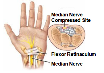 Carpal Tunnel Syndrome - Prime Rehab