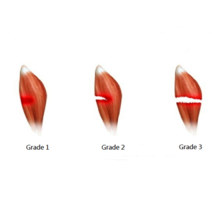 Five common football injuries(5)-Hamstring Strain - Prime Rehab Dev Site